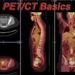 21世纪医学最伟大的发明：PET-CT